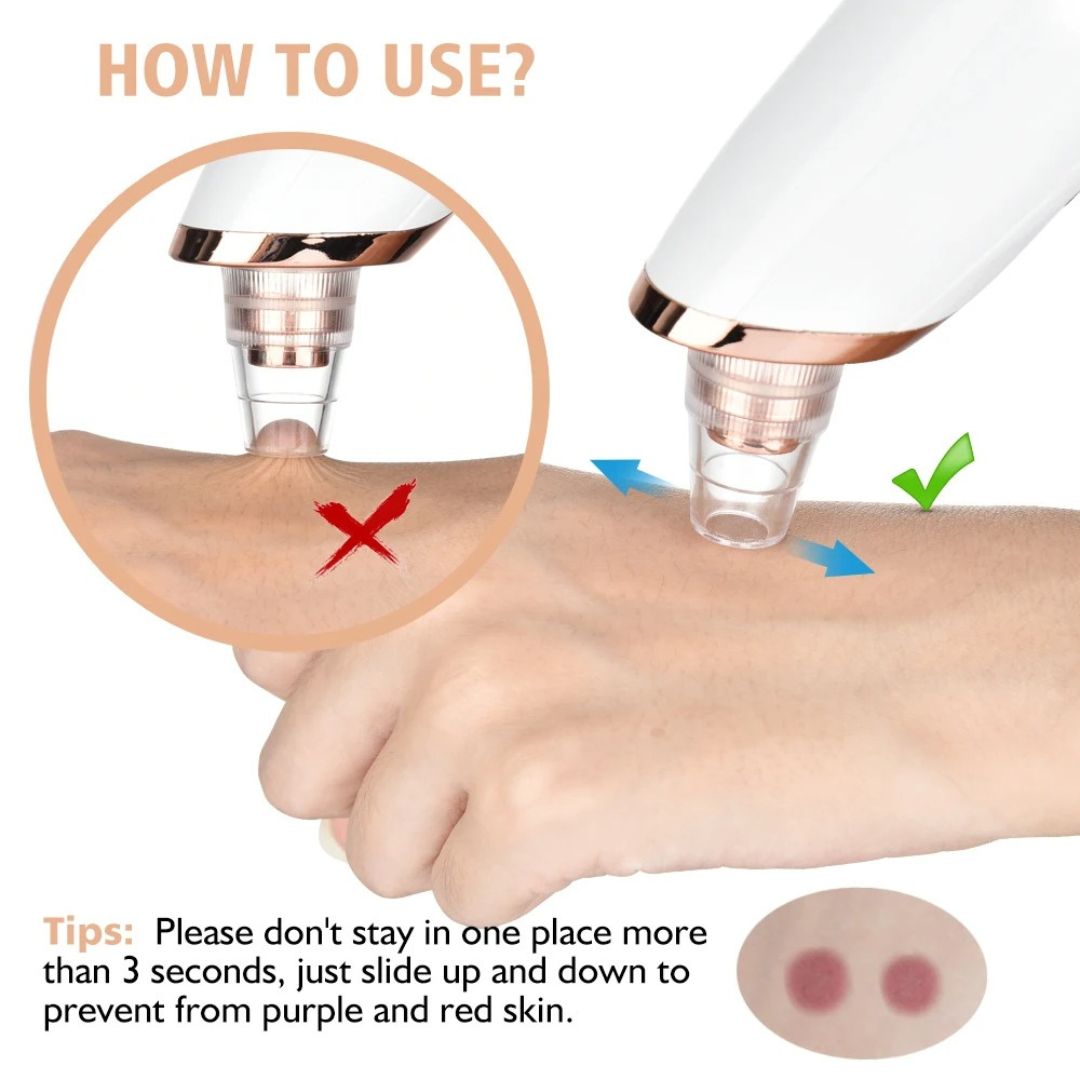PoreSonic™ Electric Acne Black Head Remover